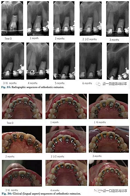 文献优秀正畸病例赏析--正畸牙周联合治疗方法病例介绍