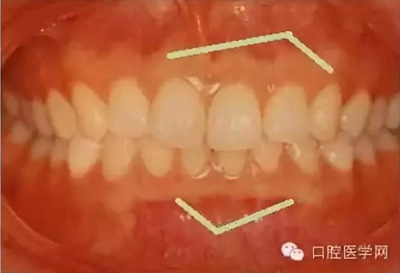 牙床骨质突起的原因和处理措施