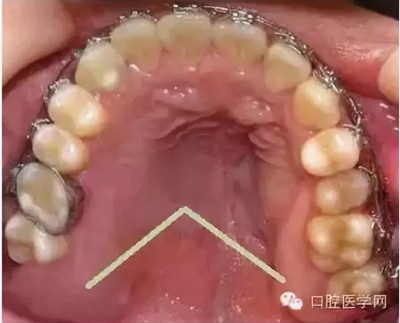 牙床骨质突起的原因和处理措施