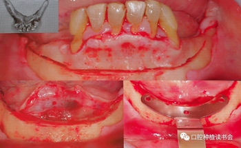 Paulo Malo &周国辉教授｜无牙颌种植修复的创新理念