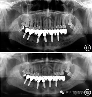 【专家笔谈】即刻种植治疗方案的评估与实施