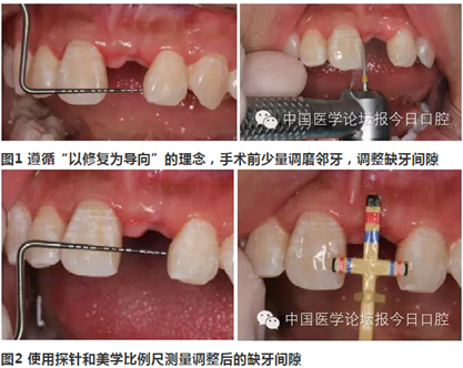 手把手教你做种植软组织成形