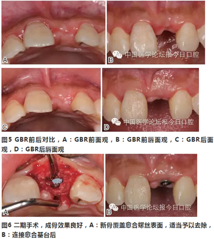 手把手教你做种植软组织成形