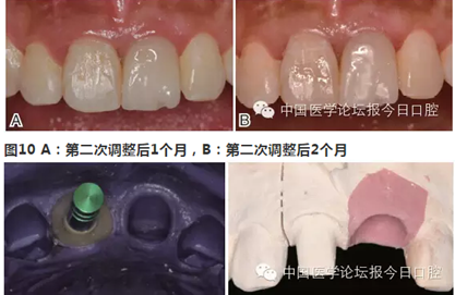 手把手教你做种植软组织成形