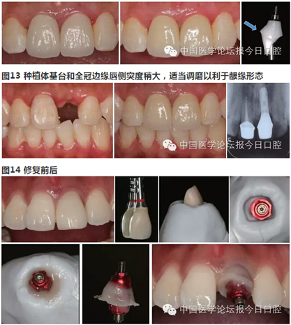 手把手教你做种植软组织成形