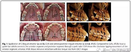 正畸文献阅读--用舌侧滑动牵引系统控制前牙区段：初步的CBCT研究