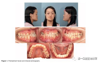 文献优秀正畸病例赏析-髁突增生性面部不对称的协同治疗1例 文献优秀正畸病例赏析-髁突增生性面部不对称的协同治疗1例
