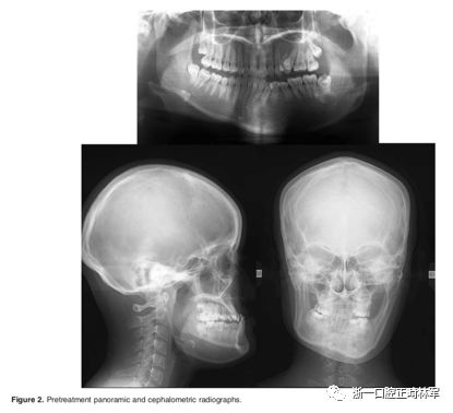 文献优秀正畸病例赏析-髁突增生性面部不对称的协同治疗1例 文献优秀正畸病例赏析-髁突增生性面部不对称的协同治疗1例