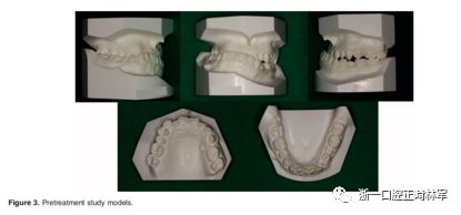 文献优秀正畸病例赏析-髁突增生性面部不对称的协同治疗1例 文献优秀正畸病例赏析-髁突增生性面部不对称的协同治疗1例