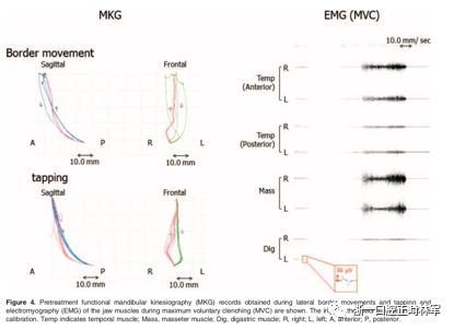 文献优秀正畸病例赏析-髁突增生性面部不对称的协同治疗1例 文献优秀正畸病例赏析-髁突增生性面部不对称的协同治疗1例