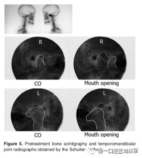 文献优秀正畸病例赏析-髁突增生性面部不对称的协同治疗1例 文献优秀正畸病例赏析-髁突增生性面部不对称的协同治疗1例
