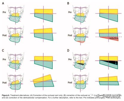 文献优秀正畸病例赏析-髁突增生性面部不对称的协同治疗1例 文献优秀正畸病例赏析-髁突增生性面部不对称的协同治疗1例
