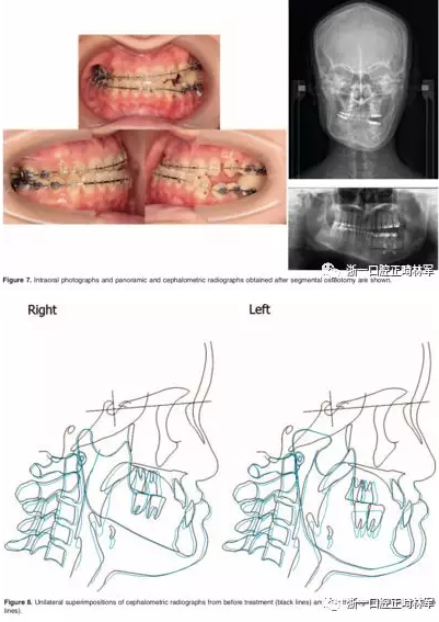 文献优秀正畸病例赏析-髁突增生性面部不对称的协同治疗1例 文献优秀正畸病例赏析-髁突增生性面部不对称的协同治疗1例