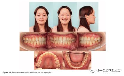 文献优秀正畸病例赏析-髁突增生性面部不对称的协同治疗1例 文献优秀正畸病例赏析-髁突增生性面部不对称的协同治疗1例