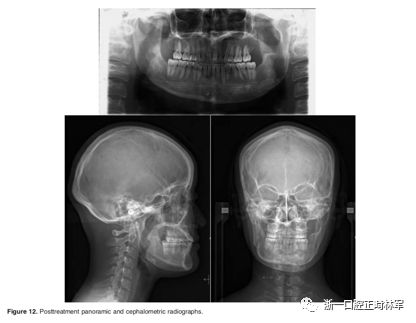 文献优秀正畸病例赏析-髁突增生性面部不对称的协同治疗1例 文献优秀正畸病例赏析-髁突增生性面部不对称的协同治疗1例
