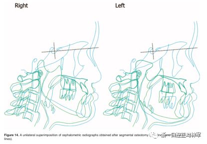 文献优秀正畸病例赏析-髁突增生性面部不对称的协同治疗1例 文献优秀正畸病例赏析-髁突增生性面部不对称的协同治疗1例