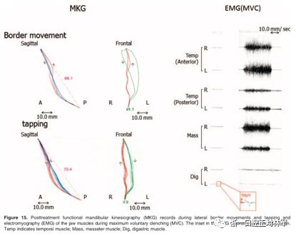 文献优秀正畸病例赏析-髁突增生性面部不对称的协同治疗1例 文献优秀正畸病例赏析-髁突增生性面部不对称的协同治疗1例