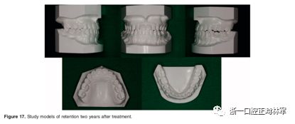 文献优秀正畸病例赏析-髁突增生性面部不对称的协同治疗1例 文献优秀正畸病例赏析-髁突增生性面部不对称的协同治疗1例