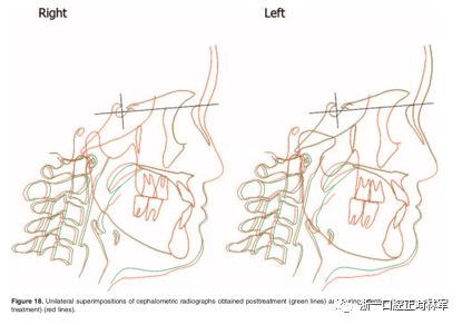 文献优秀正畸病例赏析-髁突增生性面部不对称的协同治疗1例 文献优秀正畸病例赏析-髁突增生性面部不对称的协同治疗1例