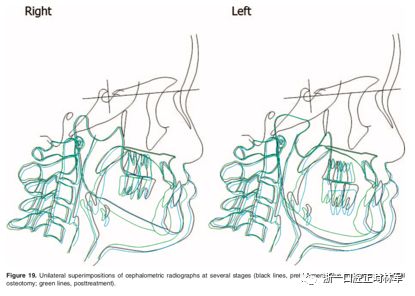 文献优秀正畸病例赏析-髁突增生性面部不对称的协同治疗1例 文献优秀正畸病例赏析-髁突增生性面部不对称的协同治疗1例