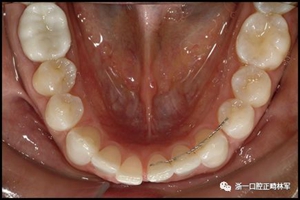 正畸文献阅读--固定舌侧保持器作用下意外的牙齿移动