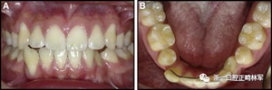 正畸文献阅读--固定舌侧保持器作用下意外的牙齿移动