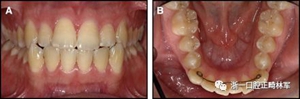 正畸文献阅读--固定舌侧保持器作用下意外的牙齿移动