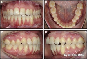 正畸文献阅读--固定舌侧保持器作用下意外的牙齿移动