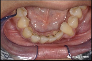 正畸文献阅读--固定舌侧保持器作用下意外的牙齿移动