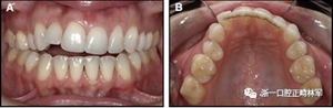 正畸文献阅读--固定舌侧保持器作用下意外的牙齿移动