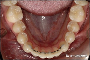 正畸文献阅读--固定舌侧保持器作用下意外的牙齿移动