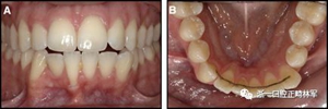 正畸文献阅读--固定舌侧保持器作用下意外的牙齿移动