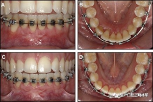 正畸文献阅读--固定舌侧保持器作用下意外的牙齿移动