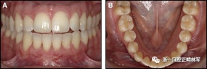 正畸文献阅读--固定舌侧保持器作用下意外的牙齿移动