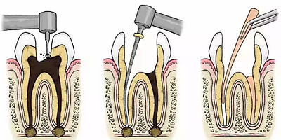 牙科学堂丨根管治疗中开放的危害