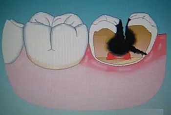 牙疼、磕掉牙、口长疱……这些急救知识你知道吗？