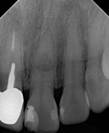 伴随根管内钙化物形成牙根内吸收治疗1例