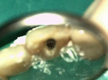 伴随根管内钙化物形成牙根内吸收治疗1例