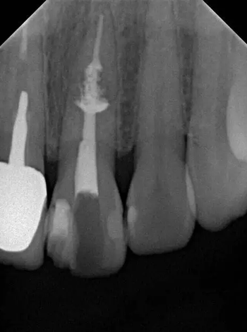 伴随根管内钙化物形成牙根内吸收治疗1例