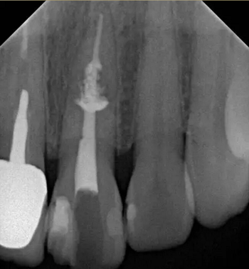 伴随根管内钙化物形成牙根内吸收治疗1例
