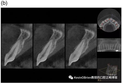 【同步新文】正畸牙根吸收是个问题吗？一项新的系统评价