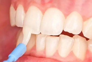 预防龋齿，口腔医生能帮我做什么？局部用氟、窝沟封闭、预防性树脂充填都是什么？