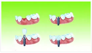 种植牙常见问答你知道多少？