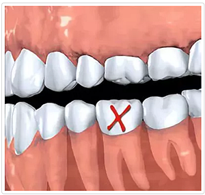 种植牙常见问答你知道多少？