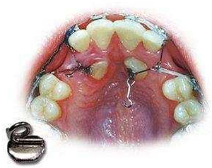 什么是 牙齿牵引？