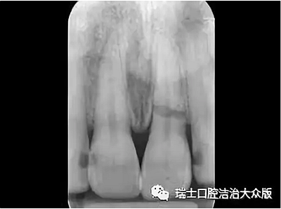 成人牙齿外伤了怎么应急处理？