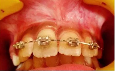 文献综述｜年轻恒牙挫入脱位的多学科治疗