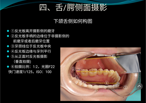 口内照摄影方法与技巧分享