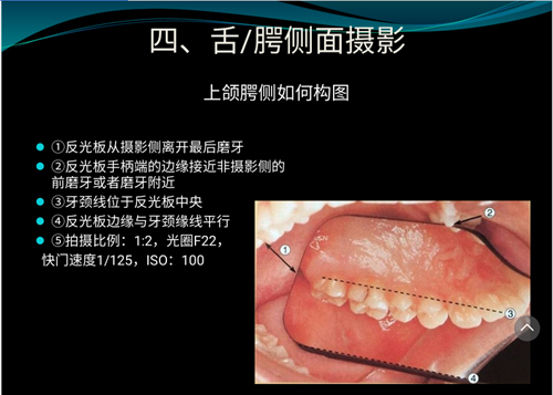 口内照摄影方法与技巧分享