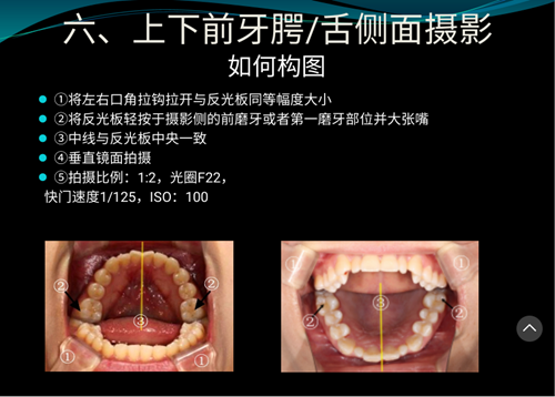 口内照摄影方法与技巧分享